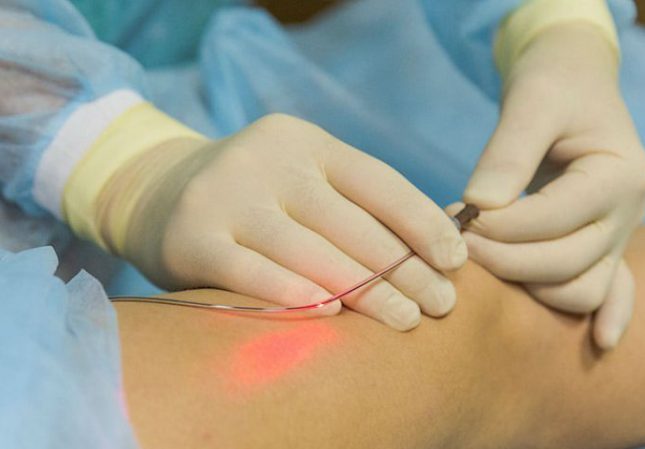 Endovenous-Laser-Therapy-Market